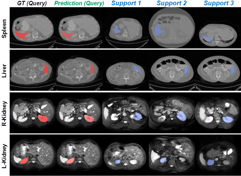 Qualitative Results - Segmentation on medical scans